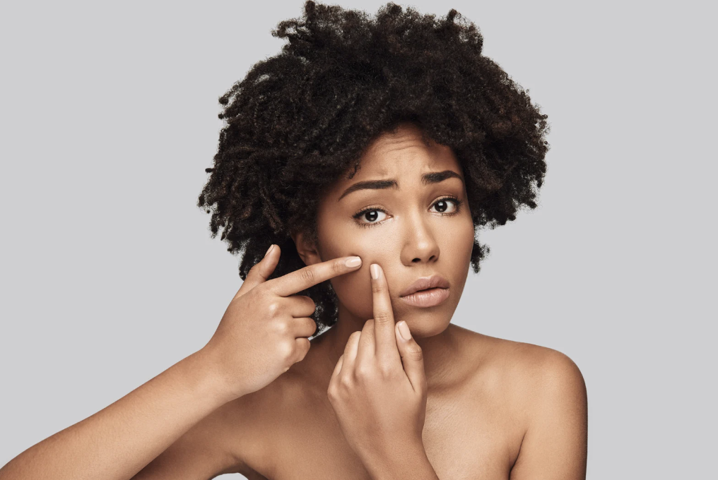 Acné hormonale : comprendre les causes et trouver des solutions durables