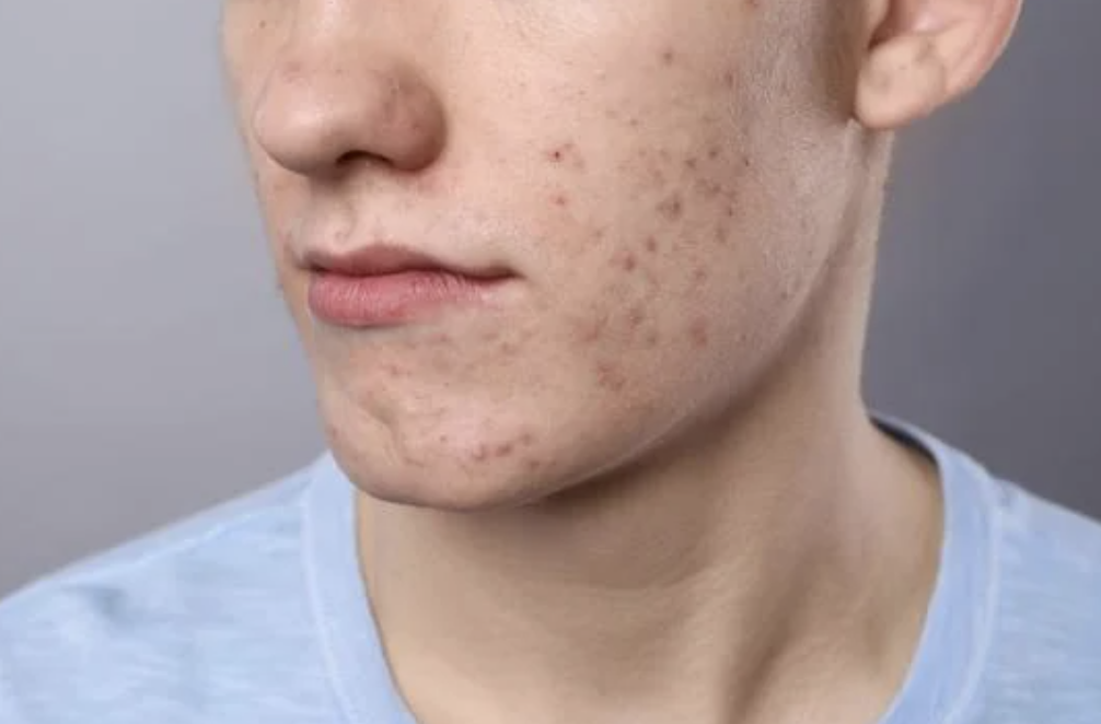 acné hormonale homme